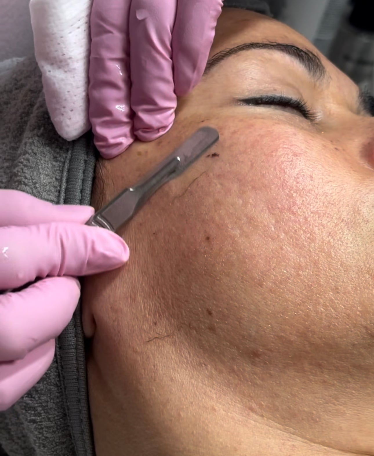 Capacitación Online Dermaplaning |