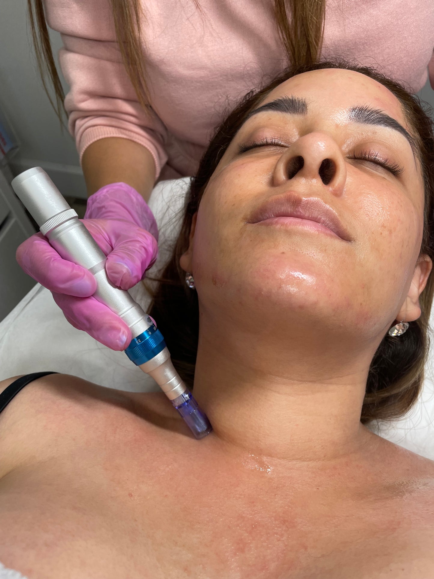 Capacitación Online Microneedling o Microagujas |