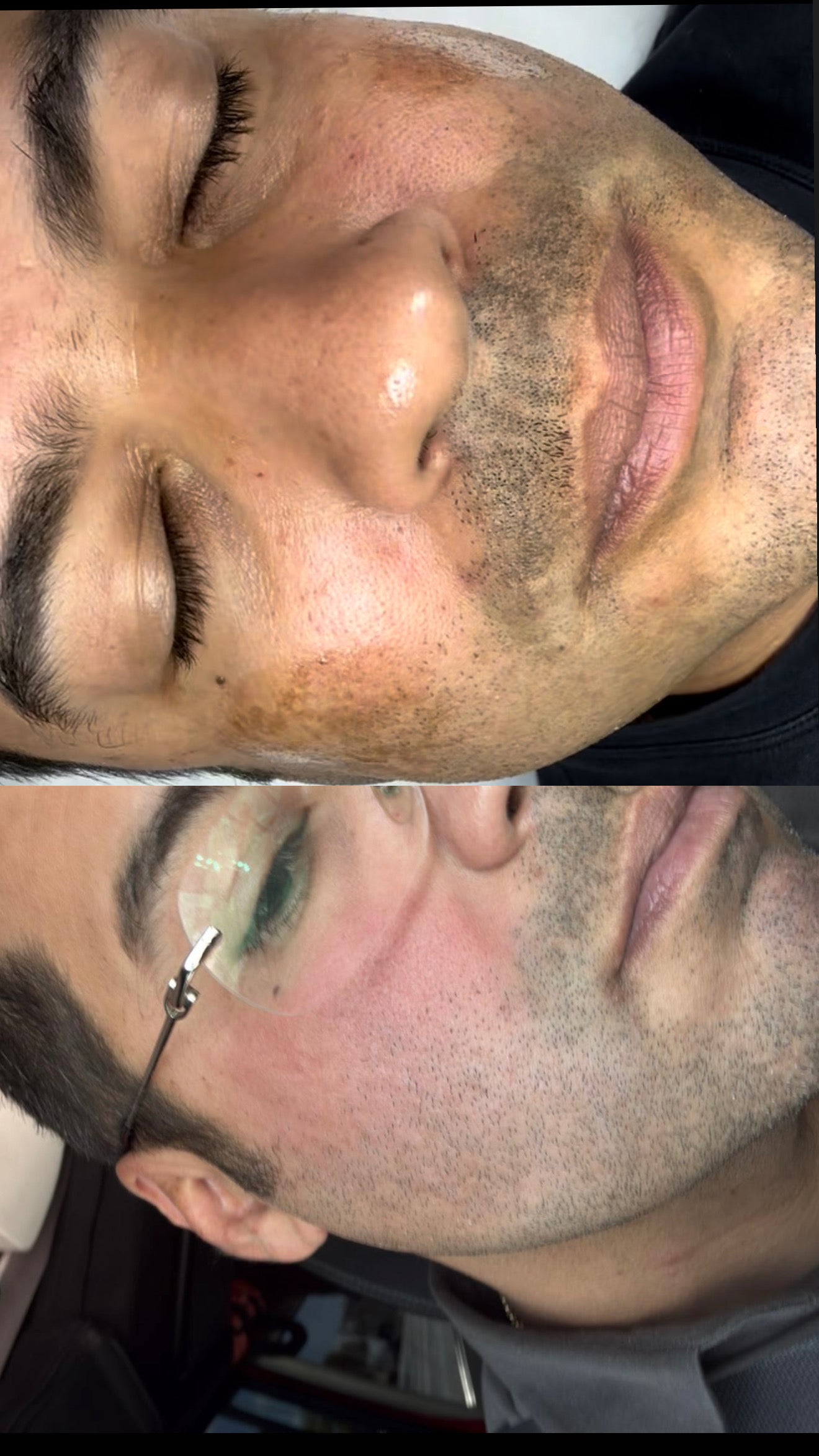 Melasma y Manchas Master Class Promo